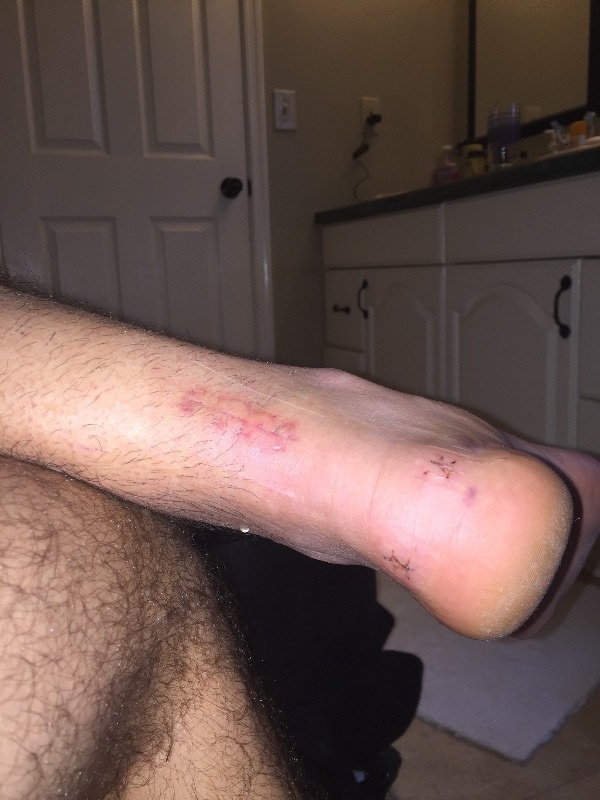 scar after week 1.JPG